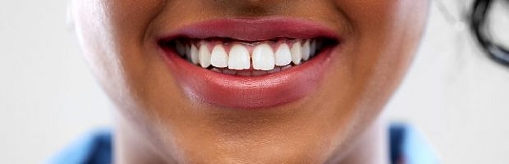 everything you need to know about take home teeth whitening