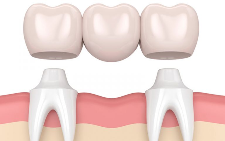dental bridges in calgary