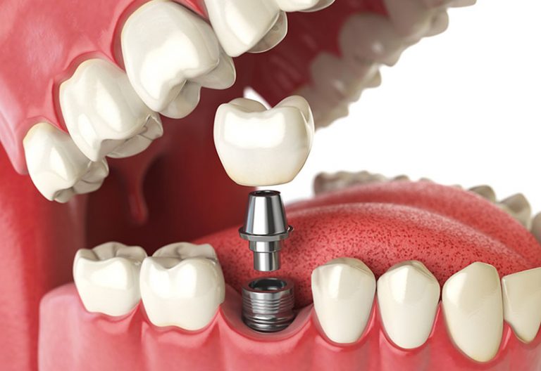 dental implants calgary