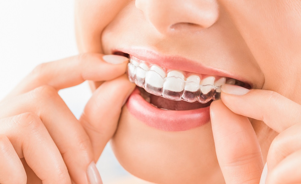 the benefits of invisalign