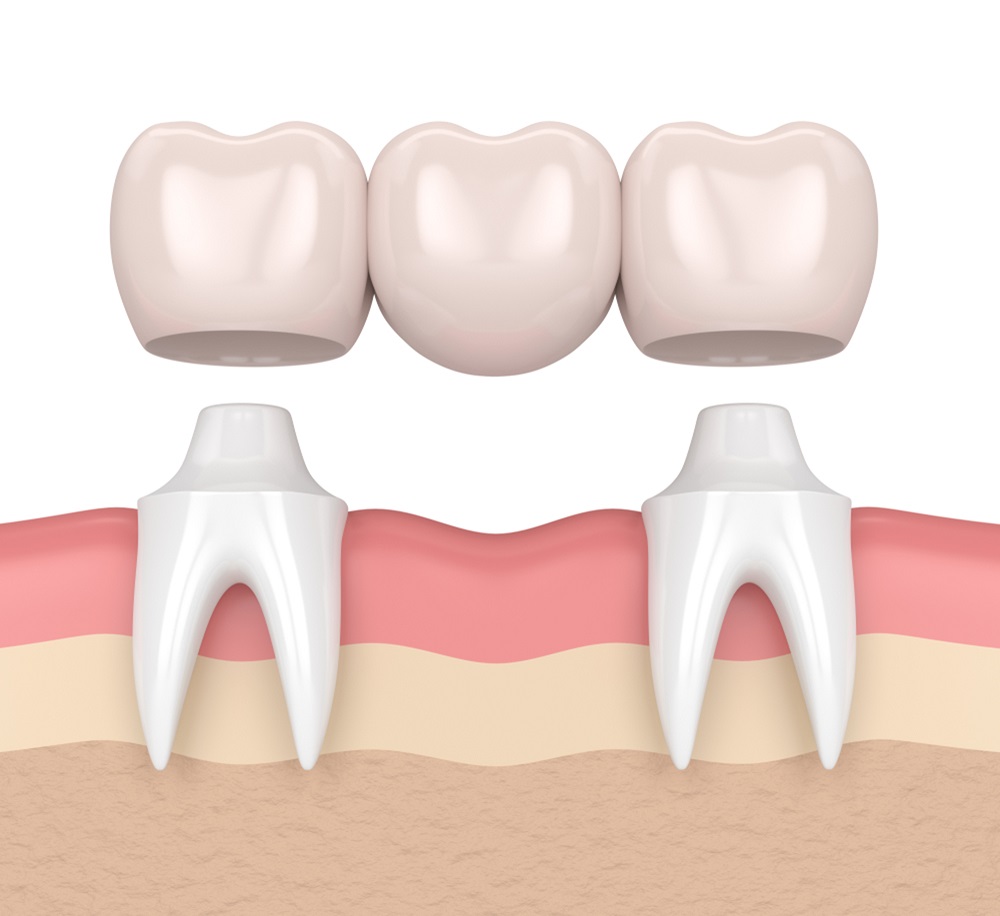 things-to-know-about-dental-bridges