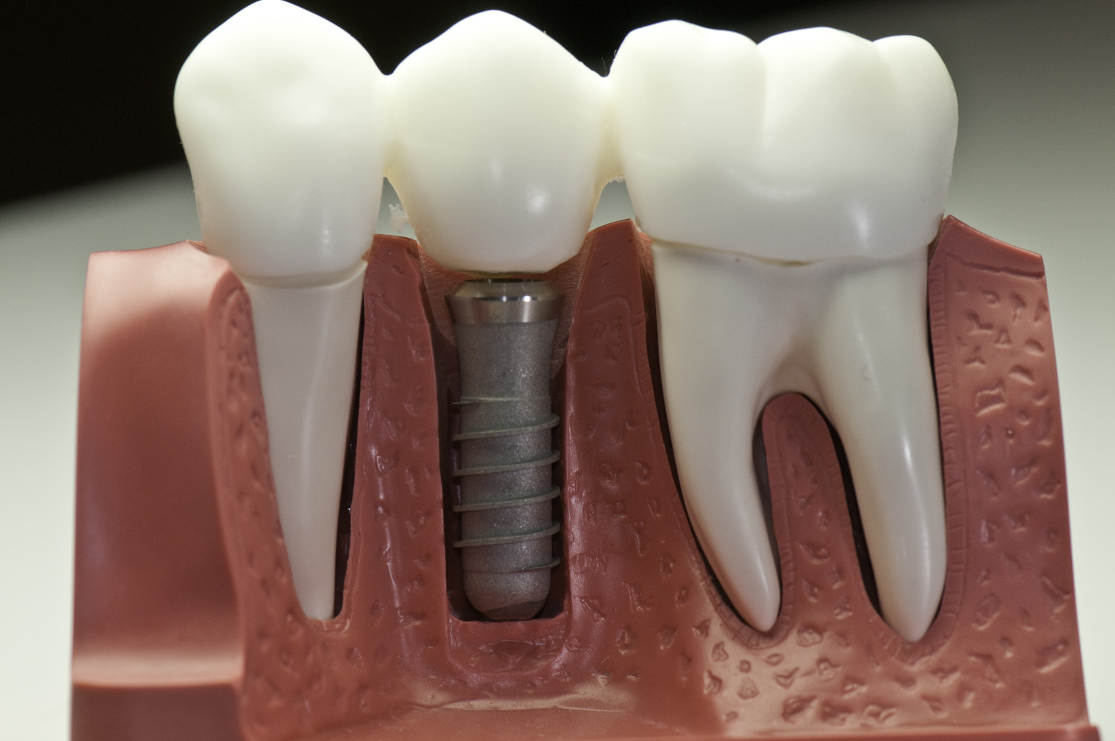 Why Dental Implants are the Best Option to Replace Missing Teeth
