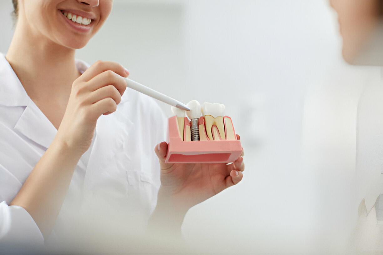 5 Long-Term Benefits of Dental Implants